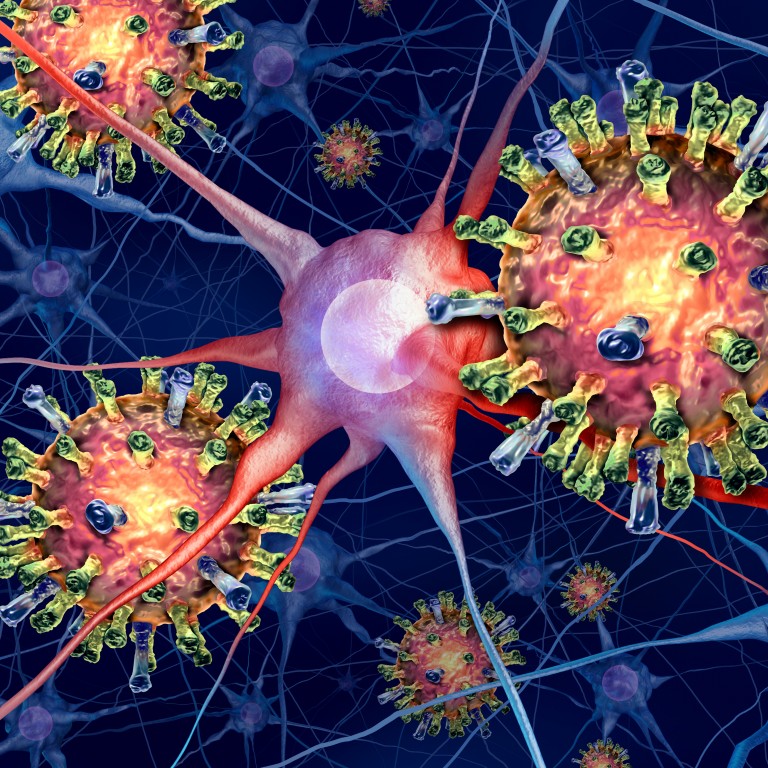 Encephalitis Infection as a measles virus in the brain